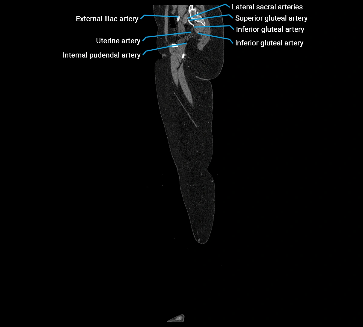 CTA lower limb sagittal cross sectional anatomy labelled image _13 (2).webp